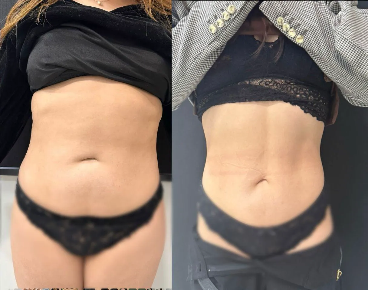 Antes e depois de abdômen feminino em acompanhamento nutrológico