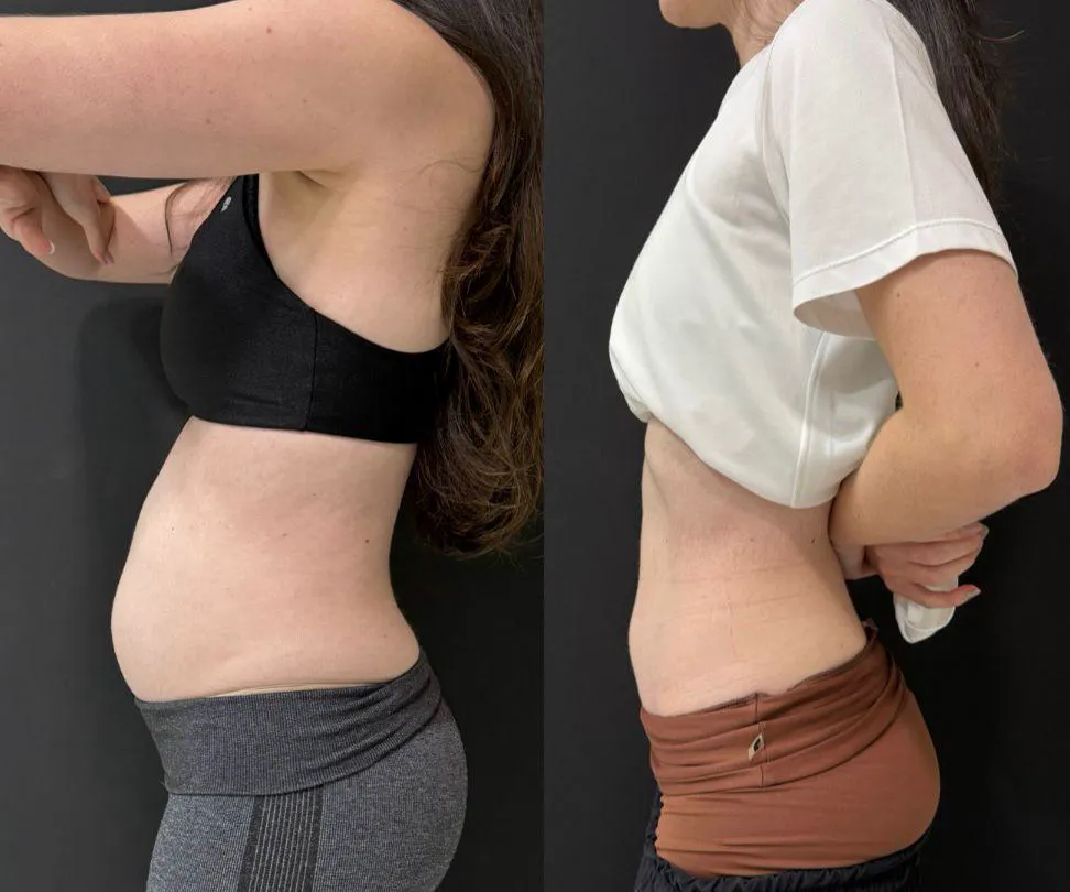 Antes e depois de abdômen em acompanhamento de composição corporal