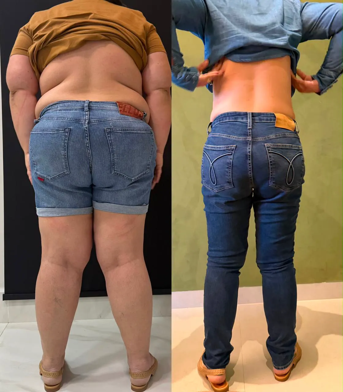 Antes e depois de costas, evolução em programa médico de emagrecimento