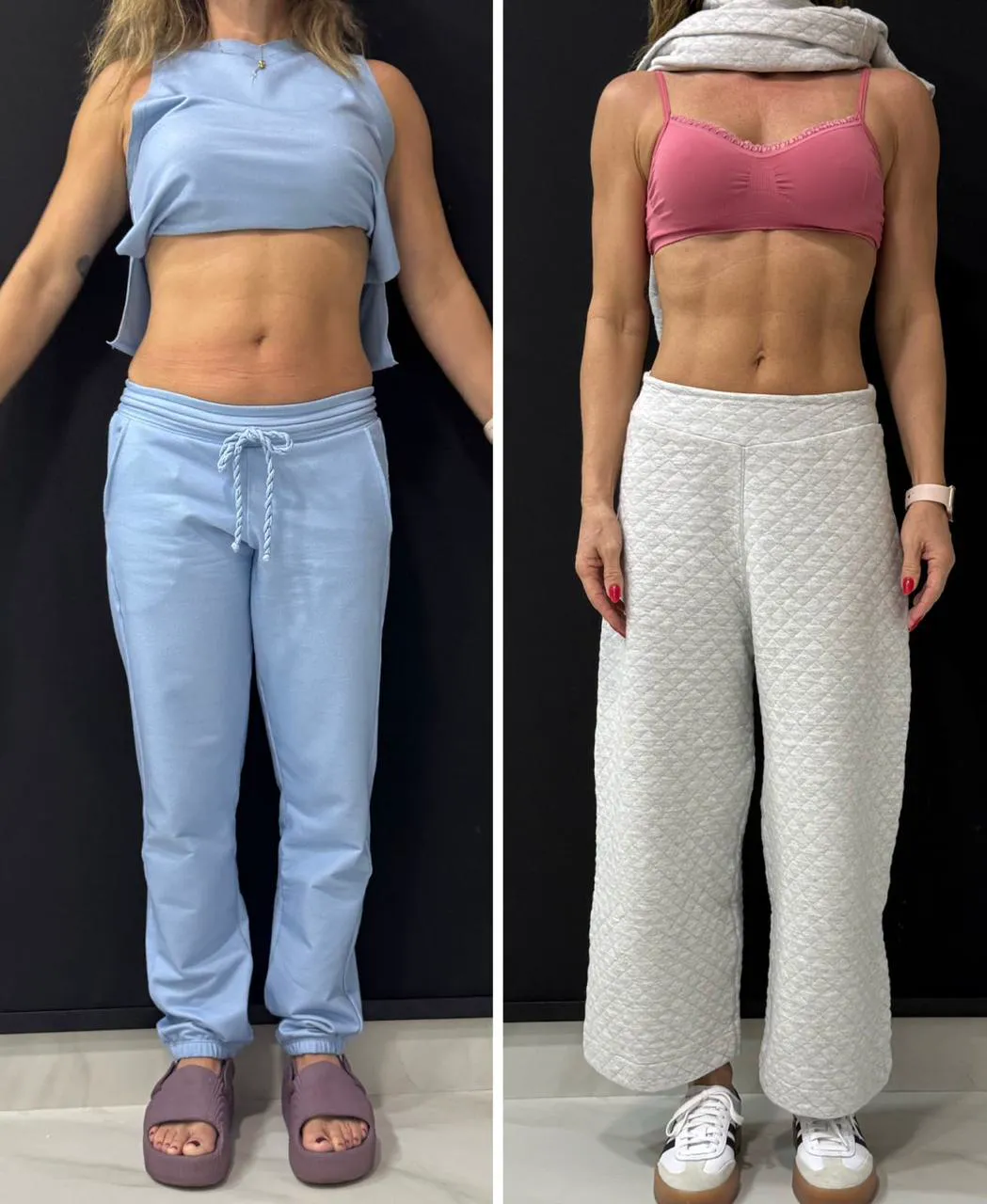 Evolução corporal de paciente da Santé Clinic, antes e depois de frente