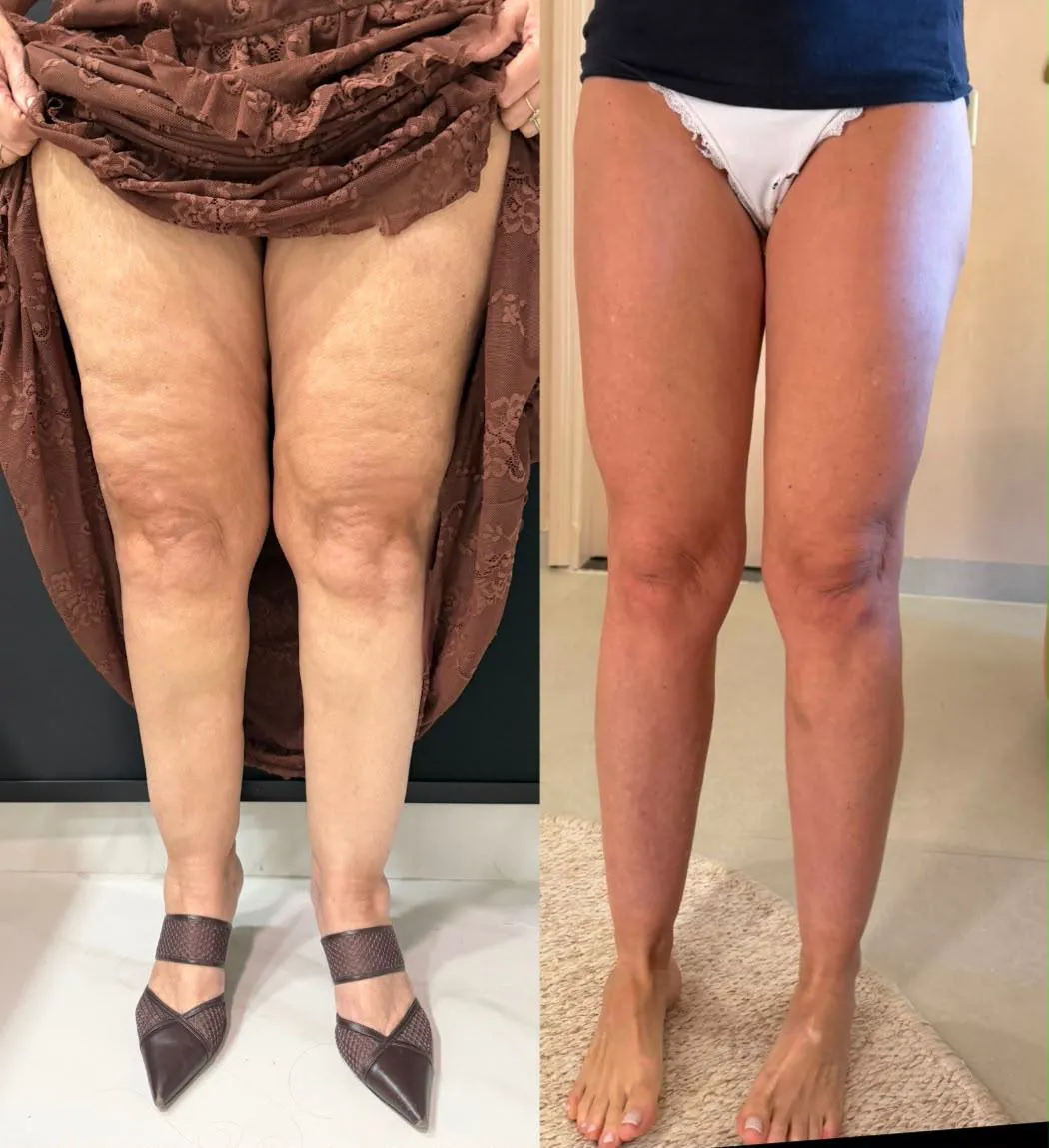 Antes e depois de pernas e firmeza, acompanhamento clínico na Santé