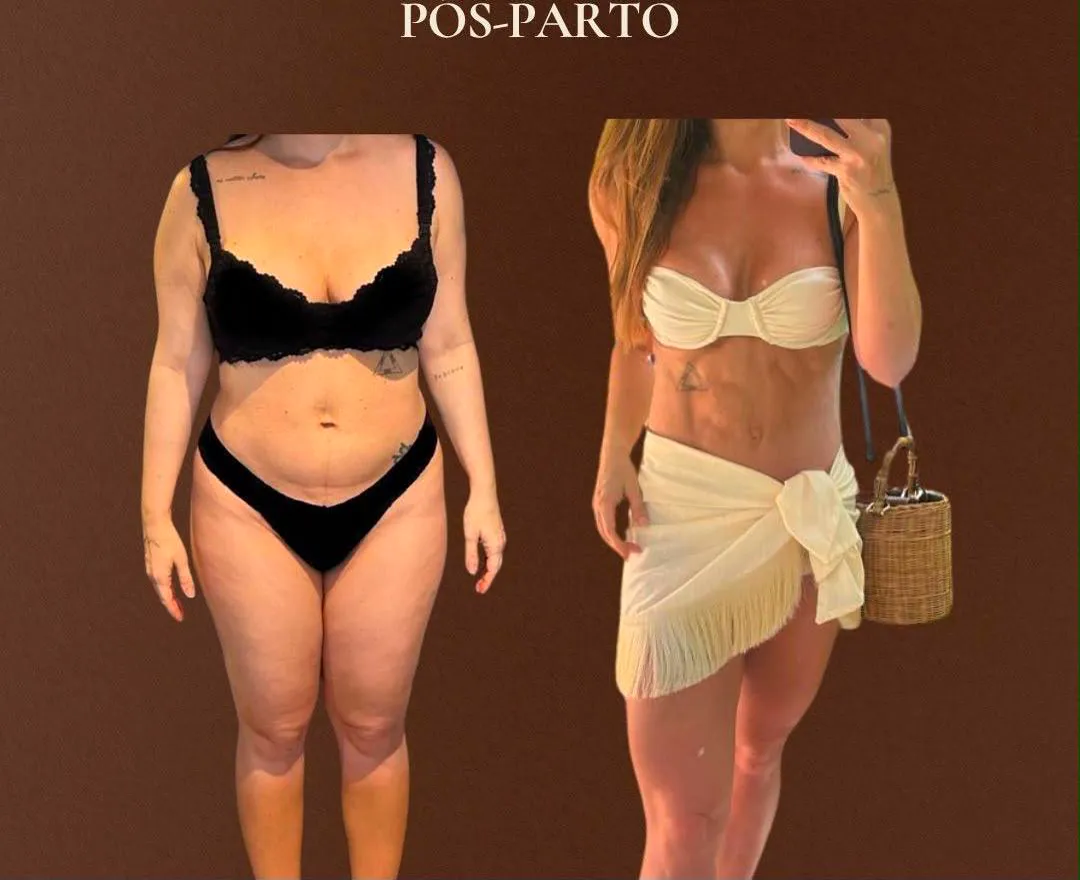 Antes e depois pós-parto em programa de emagrecimento saudável