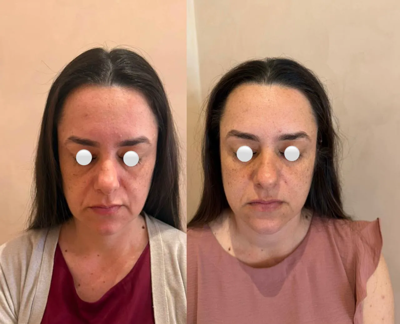 Antes e depois de volume e jovialidade no rosto durante o acompanhamento